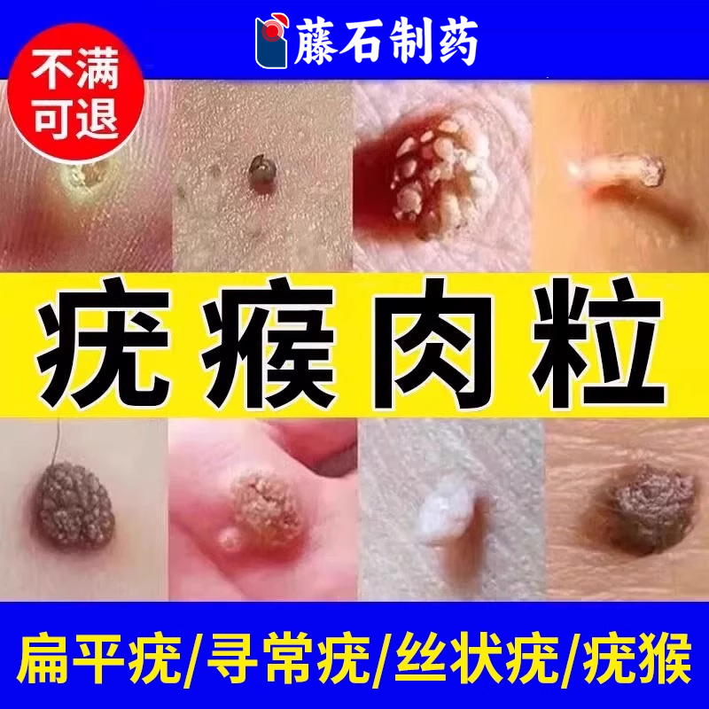 脖子上的小肉粒扁平疣丝状疣