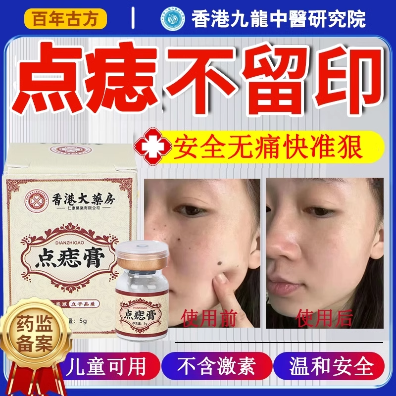 点痣膏无痕点斑去痣水志脸部专用除去黑痣祛膏取正品药房旗舰店nj