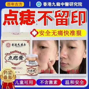 点痣膏无痕点斑去痣水志脸部专用除去黑痣祛膏取正品药房旗舰店nj