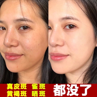 仲燕官方堂美乐清片颜素正品淡斑仙禾玉蝉旗舰店复方熊果苷乳膏