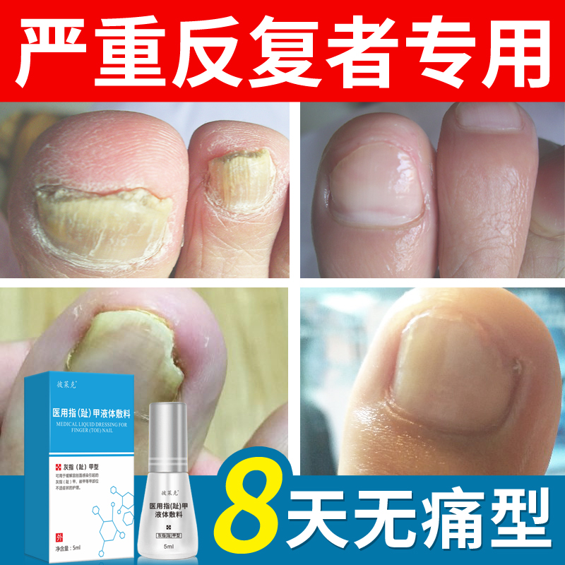神笔灰甲灰指甲专用去除增厚抑菌液治療藥软甲脱甲膏冰醋酸正品