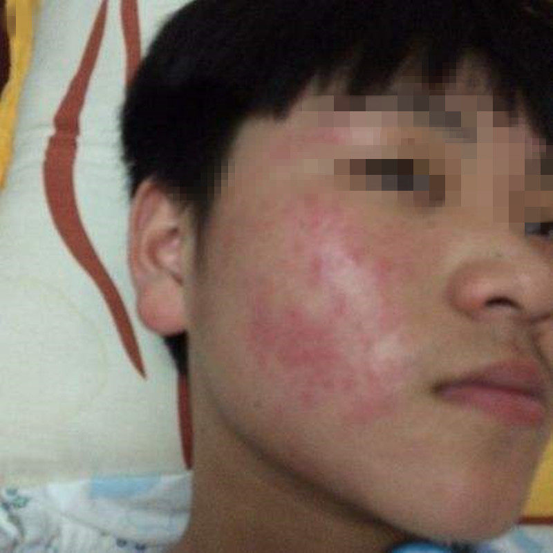 净敏抑菌凝胶脸部红痒过敏全身瘙痒蚊虫叮咬30克