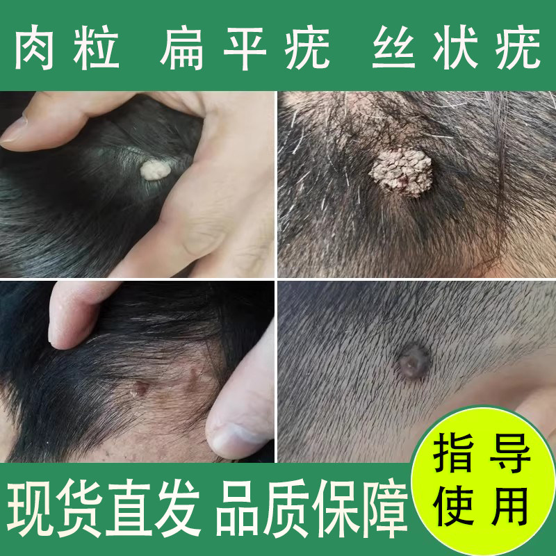 佰草钟医医用退热凝胶去除脖子腋下扁平疣丝状疣肉粒鸡眼趾疣猴子