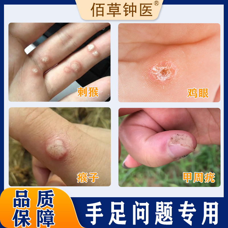 佰草钟医手足问题脚底鸡眼跖疣手上瘊子肉刺手指甲周疣膏