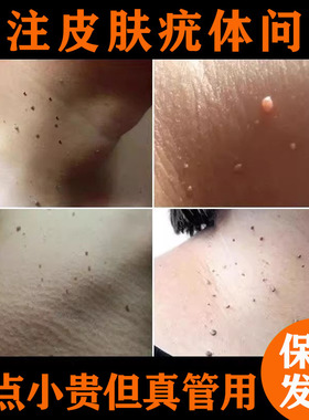 脖子脸上小肉粒黑痣身上皮赘扁平疣丝状疣瘊子膏