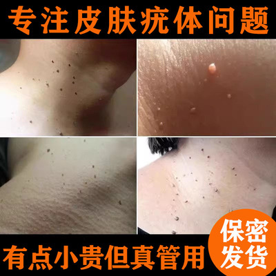 脖子小肉粒黑痣扁平疣丝状疣