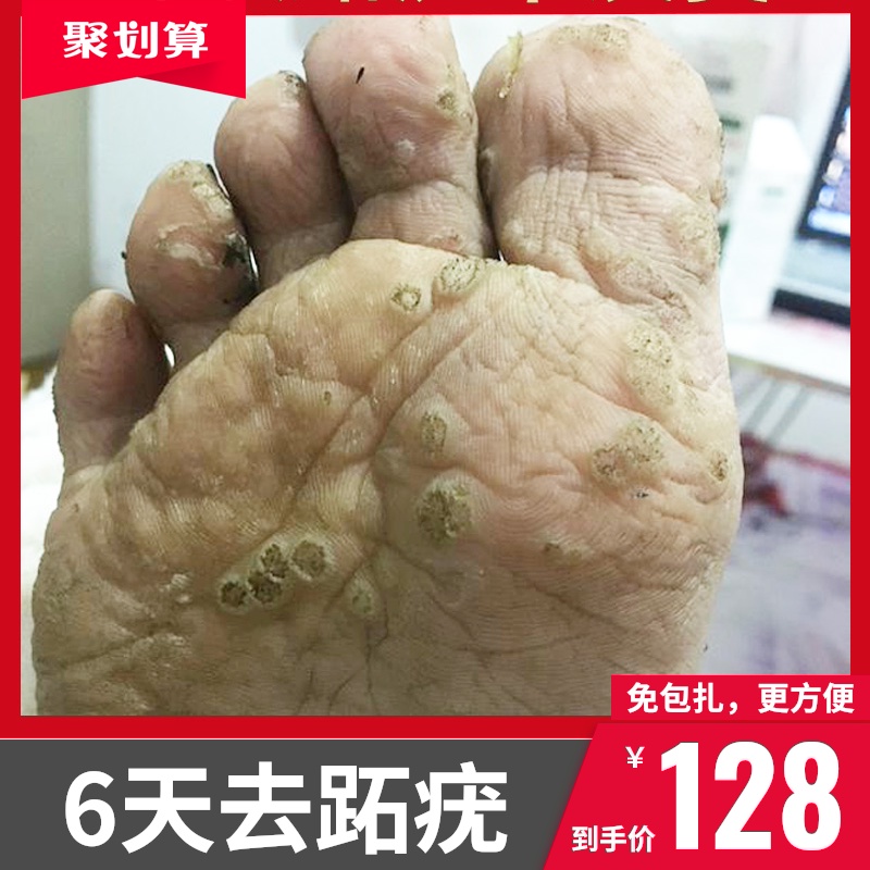 跖疣去除日本去根足部病毒膏专用净去疣灵趾拓疣脚上长瘊子鸦胆子