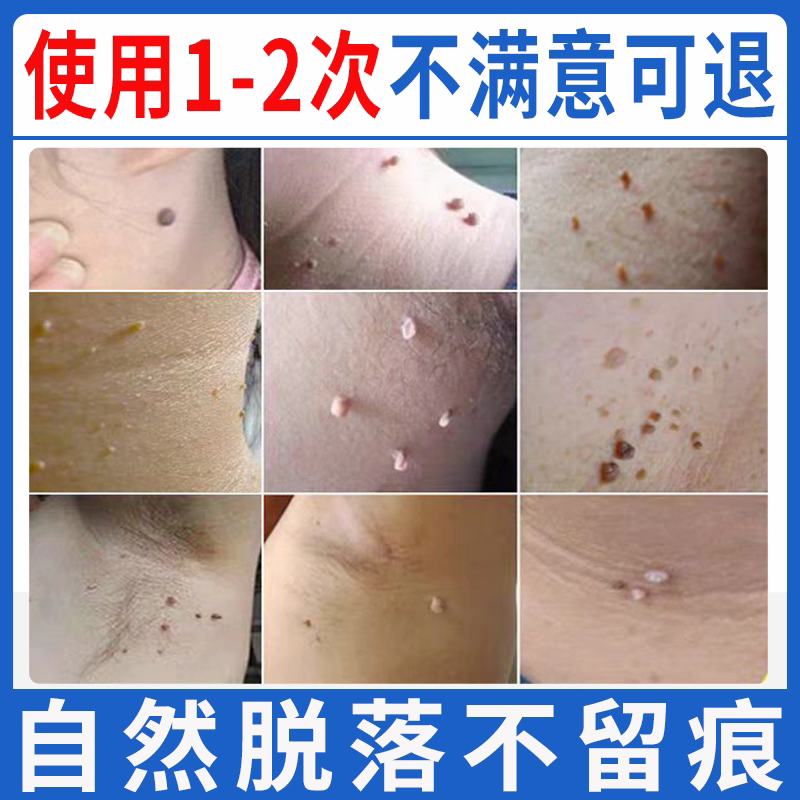 痦子点痣贴手足脚垫肉刺老茧黑痣鱼休子鱼鳞痣脖子黑点肉痣