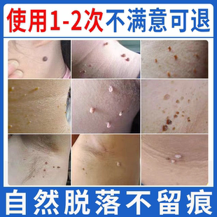痦子点痣贴手足脚垫肉刺老茧黑痣鱼休子鱼鳞痣脖子黑点肉痣