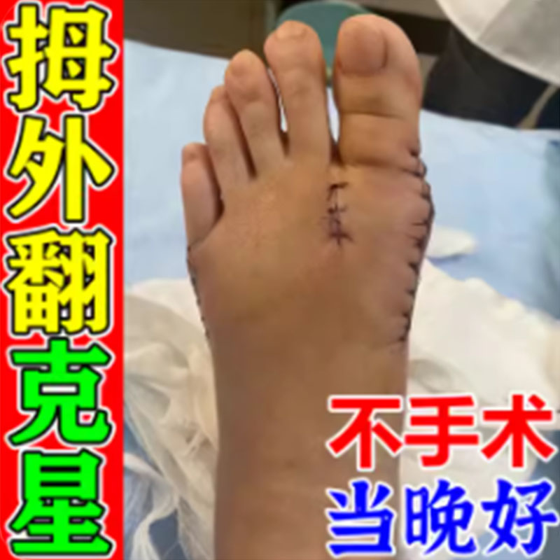 不手术】拇指外翻矫正神器大脚骨脚趾关节疼痛严重变畸形药膏贴xa