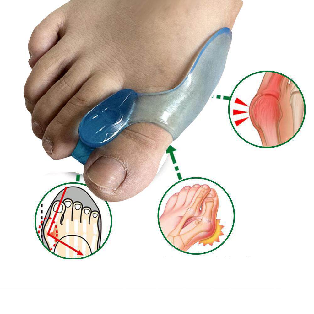 透明蓝硅胶拇指外翻器脚趾分离器大脚骨外翻器防磨脚趾套
