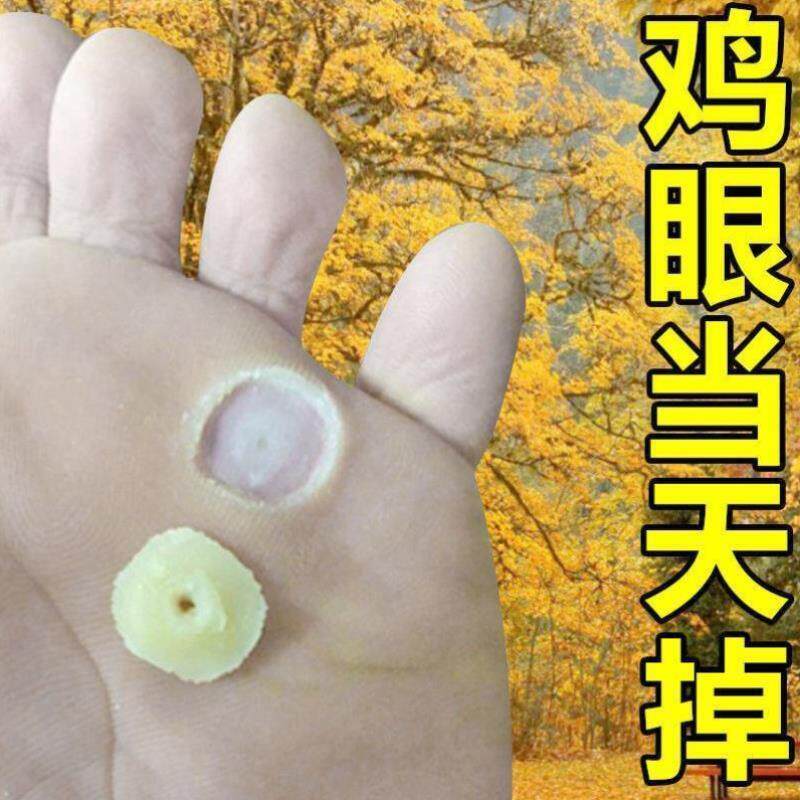 鸡眼膏贴【自然脱落】去除脚底手上顽固性老茧鸡眼肉刺脚趾跖疣膏