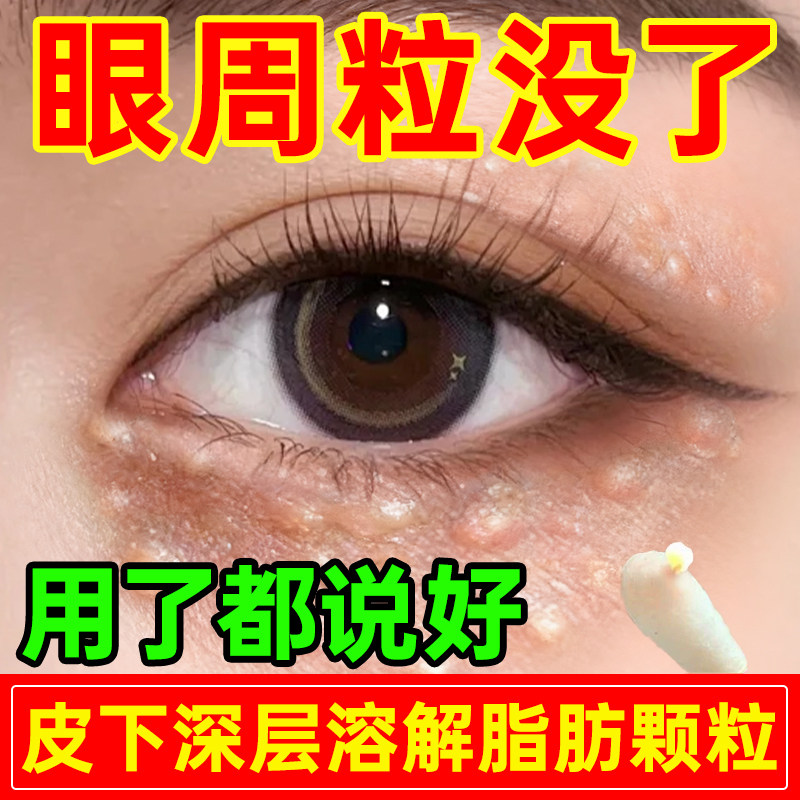 仁和匠心脂肪粒去除神器汗管眼部眼周瘤眼霜药祛专用膏官方旗舰店