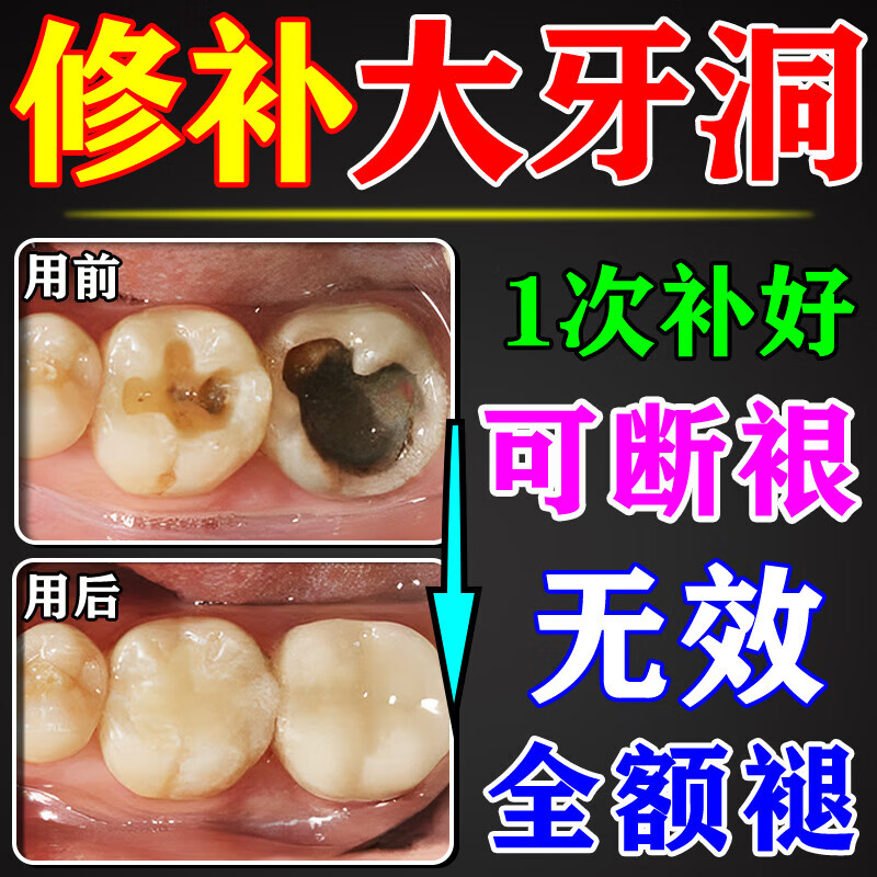 补牙神器自己填充材料永久医用在口腔护理设备礼盒