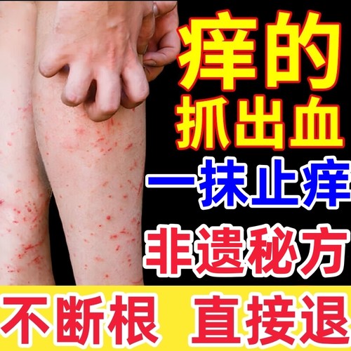 非遗传承！一抹止痒！