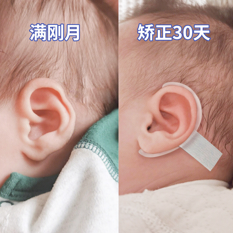 婴儿耳朵矫正器新生的儿耳廓矫形贴纠正塑形定型牵引器外耳垂宝宝