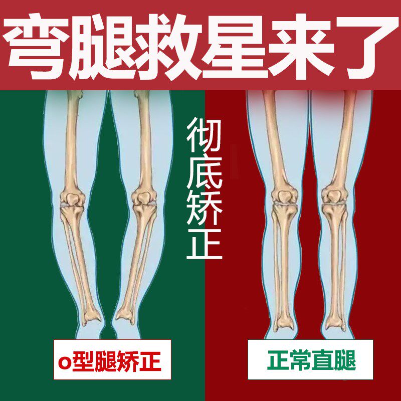 【腿变直了】外翻xo型腿小腿纠正女罗圈腿矫正器直腿神器男女通用