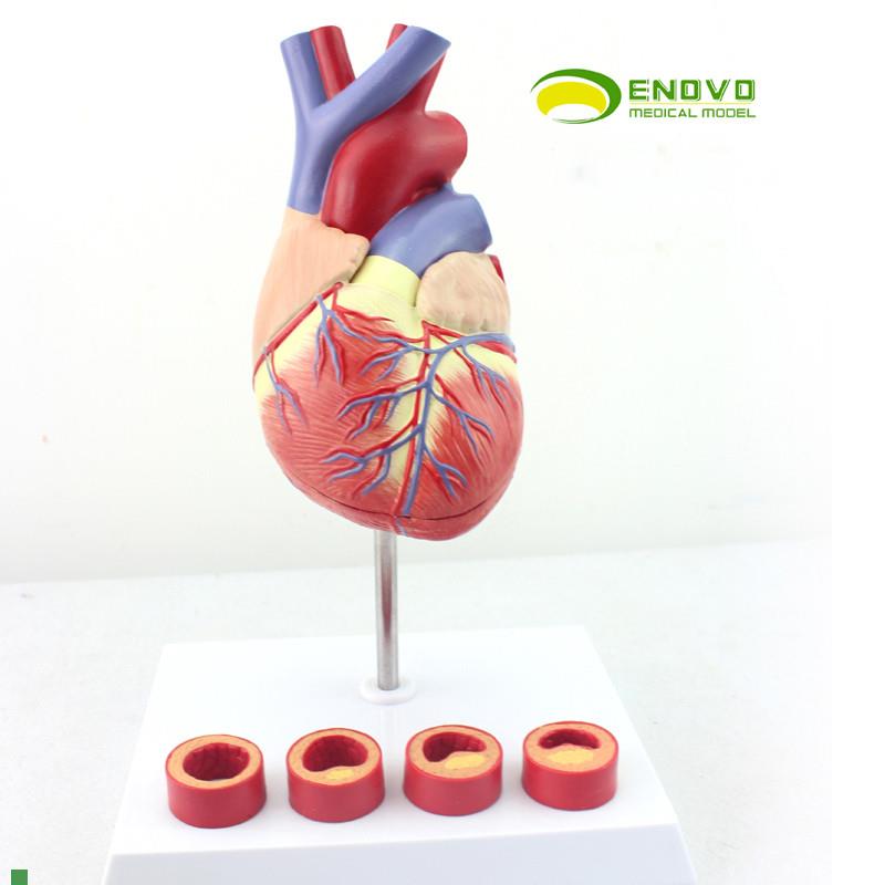 ENOVO颐e诺1:1医学人体心脏模型冠状动脉血栓心内科教学动脉粥样