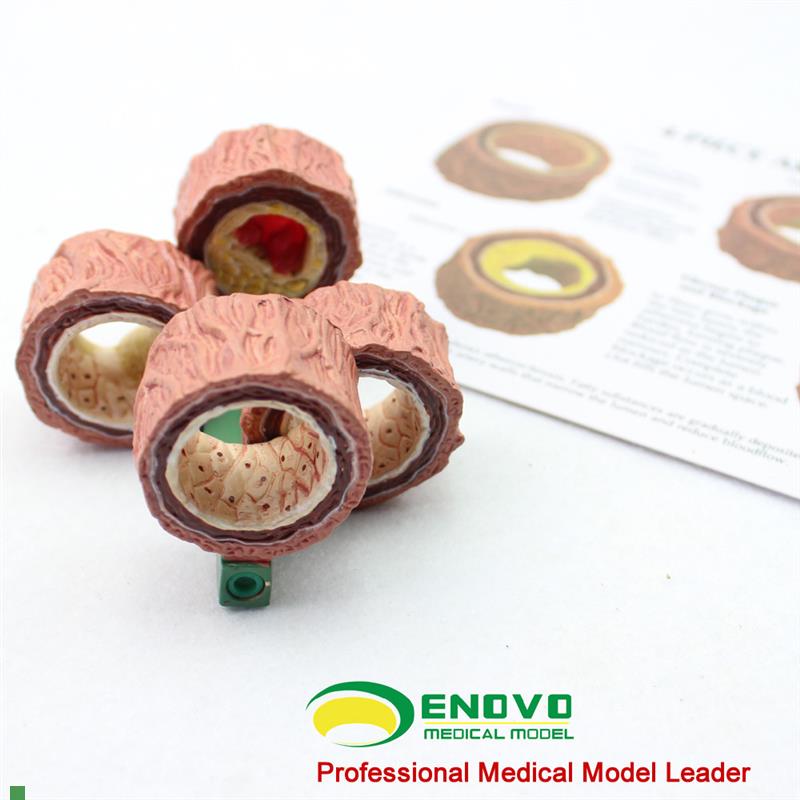 颐诺正品动脉粥样硬化模型血栓病变L模型心血管模型内科学