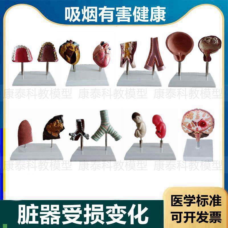 心脏模型病理正常对比吸烟有害心血管肺气管口P腔牙齿戒烟警示教