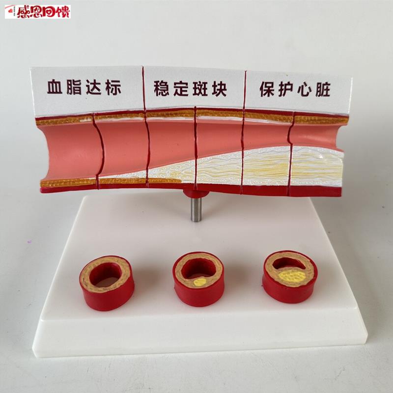 血管/堵塞动支脉粥样/硬化心血管动脉/ 硬化模型血管Z病理模型血