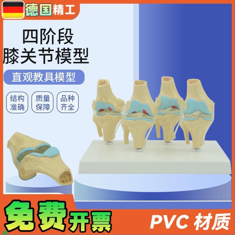 德国】人体膝关节模型正常v与病理对比教具医药礼品医患沟通道具