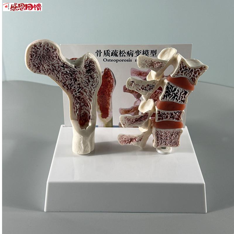 康泰医学教具骨质疏松模型骨密度变化骨折病变人体I骨骼脊柱椎间