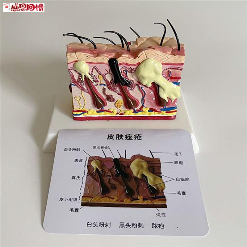 青春痘皮肤模O型人体皮肤放大面部皮肤美容教学模具痤疮医药促销