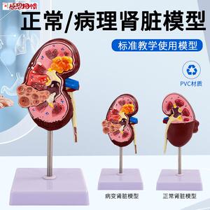 人体病变肾上腺模型肾脏解剖模型肾Y模型生殖泌尿科 肾病理模