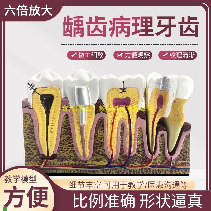 综合龋齿病理模型牙神经r牙模牙科模型牙齿模型口腔模型牙模型牙