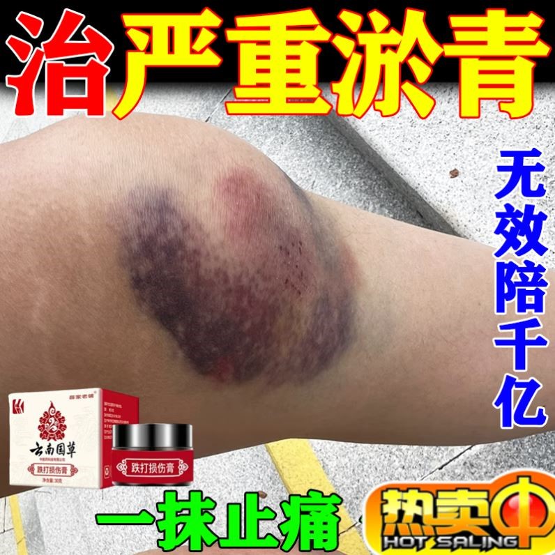 淤青快速化瘀外用膏摔伤跌打损伤消撞伤发紫专用