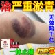淤青快速化瘀外用膏摔伤跌打损伤消撞伤发紫专用