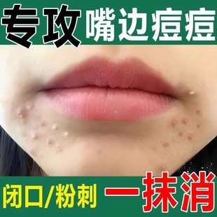 去淋巴痘腮边痘嘴巴周围脸上脖子长痘痘下巴闭口粉刺祛痘药膏