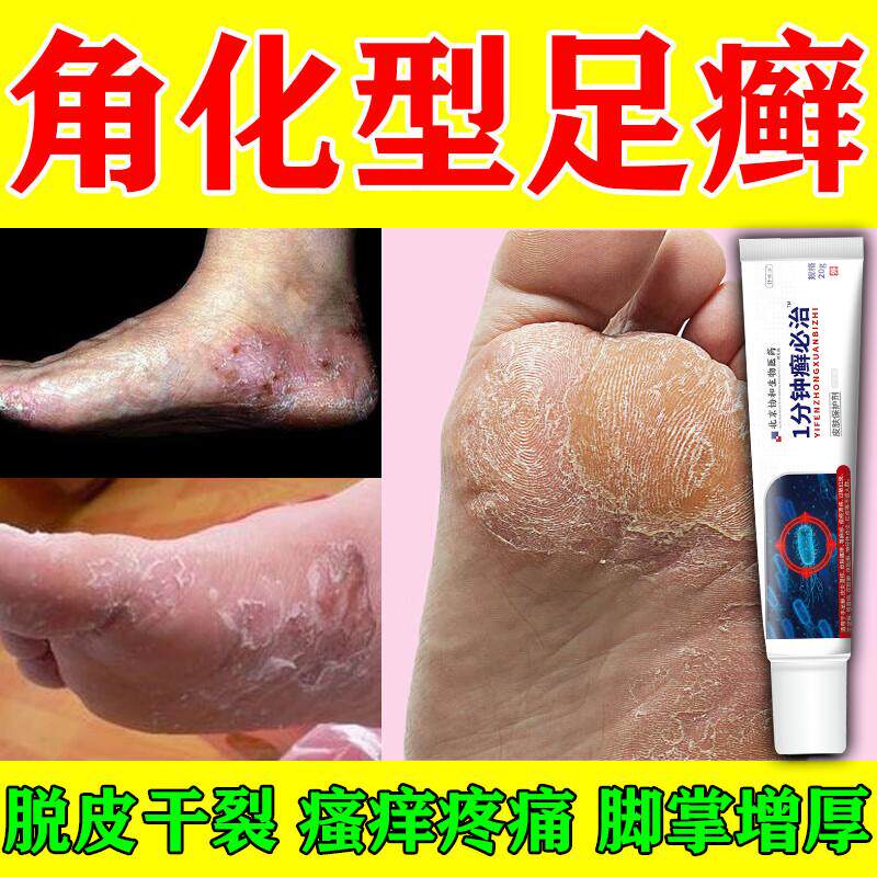 角化型足癣脚癣一次膏净真菌感染去脱皮干裂止痒杀菌烂脚丫qo