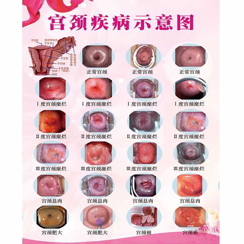 疾病示意图e妇科墙贴病变级别海报炎症子宫图片美容院挂图广告