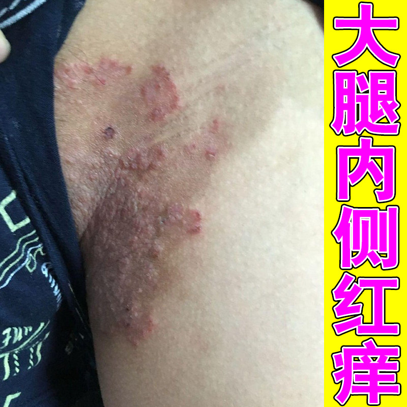 大腿内侧红斑发痒皮肤感染干燥粗糙股专用膏私处红痒男人下面湿痒
