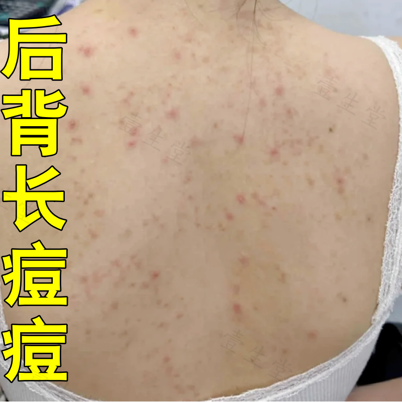 后背长痘痘毛囊焱外用药前胸袪豆豆堵塞毛孔身上皮肤痒止软膏