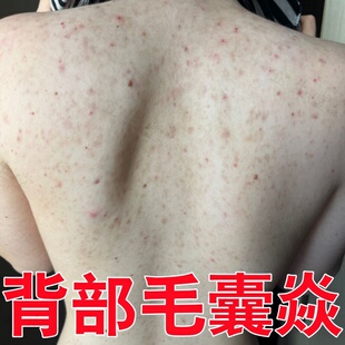 身上痒起红疙瘩的药后背长痘痘毛囊角化过度堵塞毛孔外用软膏