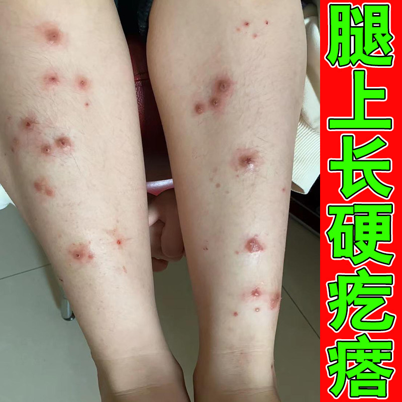 腿上硬疙瘩小腿痒身上长结节性硬疙瘩皮肤粗糙干燥草本修护软膏