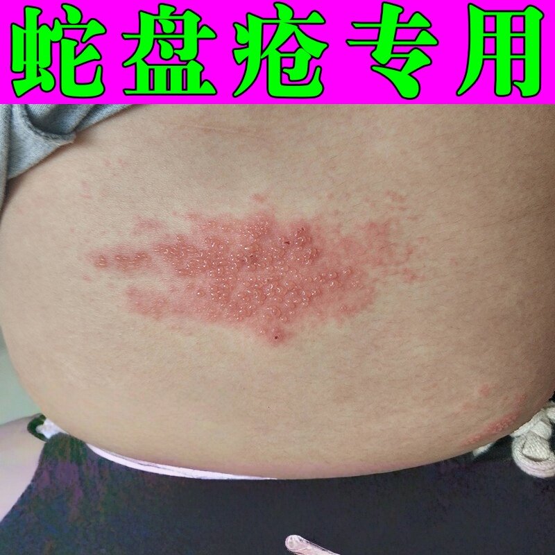 蛇盘疮后遗症修复药神经蛇缠腰痛带龙状火疱丹蛇胆飞蛇盘丹疮软膏