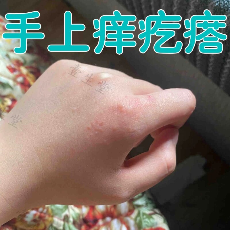 手背痒起疙瘩手上起小水泡皮肤干皮肤消毒护理（消）
