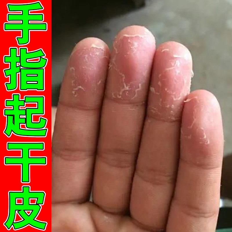冶手指起干皮脱皮干燥外用草本保湿软膏换季皮肤感染干燥粗糙起皮
