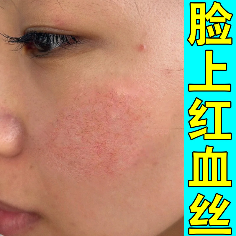 脸上长红血丝泛红发痒皮肤干燥感染过敏专用草本软膏脸颊敏感泛红