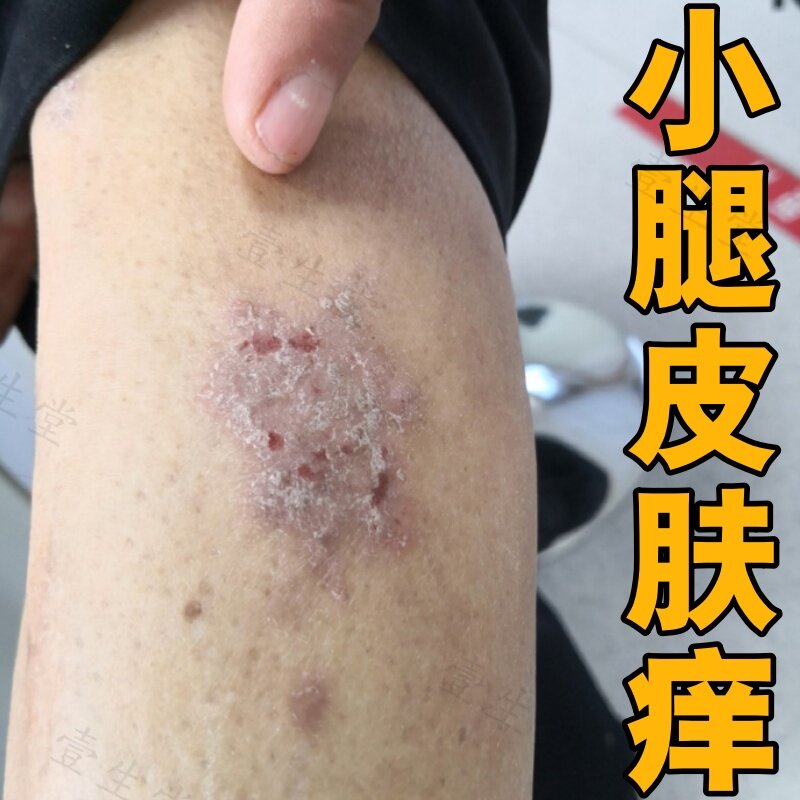 多年腿部藓长小红斑痒止修复药有过敏溢脂性腿焱皮肤起皮外用乳膏