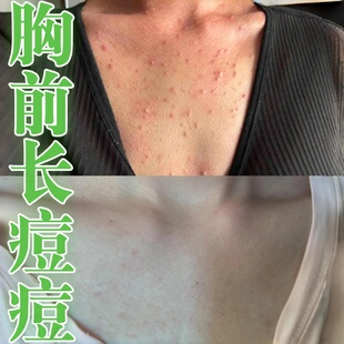 胸前长痘痘的药身上皮肤痒有马拉色菌性过敏豆豆痒止外用软膏