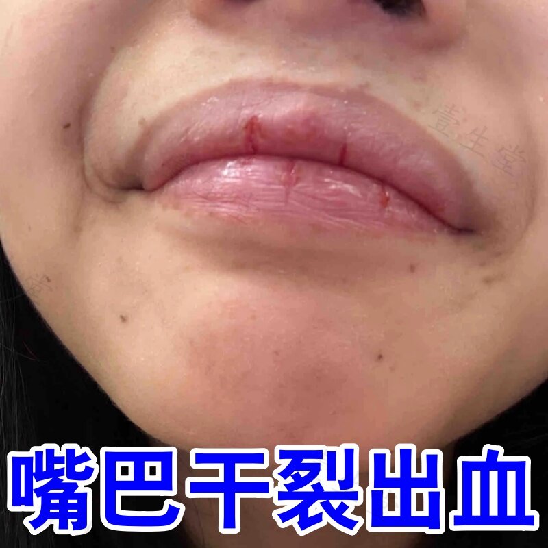 嘴巴干燥起皮出血疼外用软膏慢性皮肤消毒护理（消）