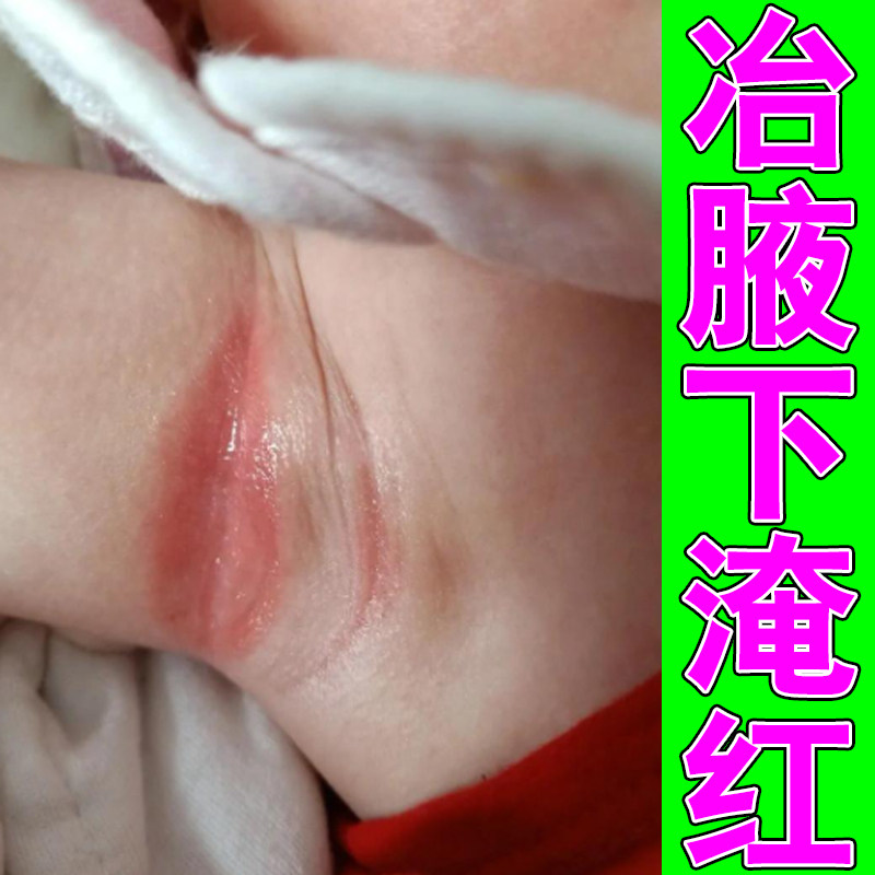 冶腋下淹红肿疼痛胳肢窝出汗泛红发痒有异味专用草本软膏皮肤干燥