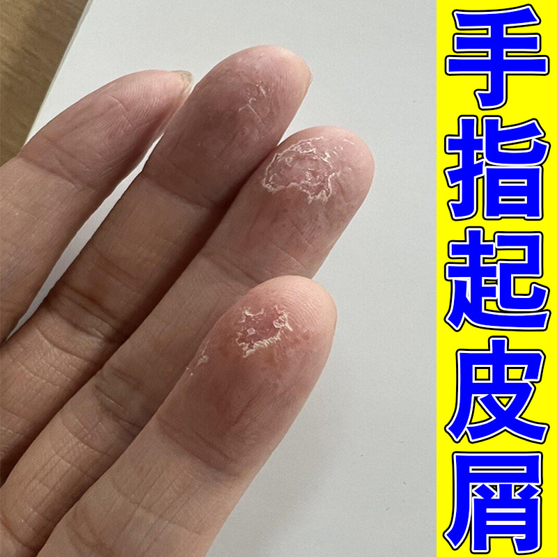 手指起皮脱皮掉屑皮肤干燥粗糙草本保湿软膏换季皮肤感染手指脱皮