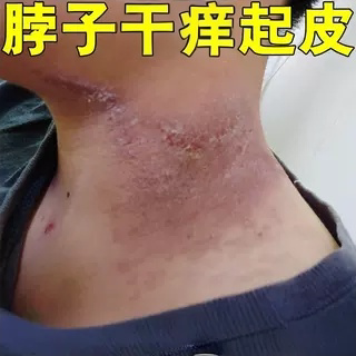 脖子上干痒起皮难耐草本修护软膏脖子红痒过敏干燥起皮日光性皮肤
