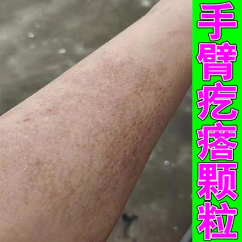 手臂长小疙瘩颗粒皮肤干淀燥粉粗糙样发变痒专用膏小腿胳膊皮肤痒